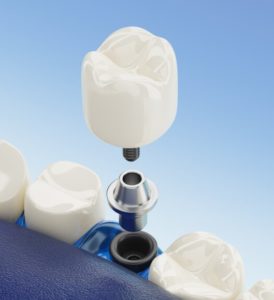 Implantater tandlæge Haderselv