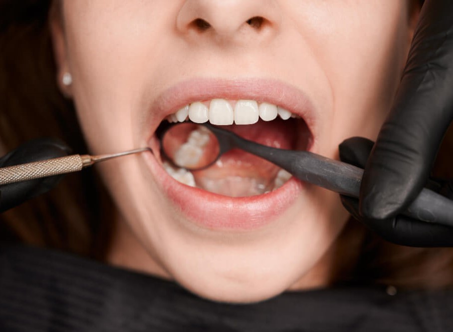 Billede af tandfyldning hos tandlæge