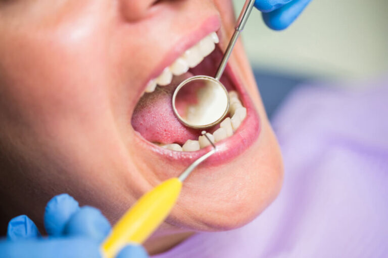Fjernelse af tandsten hos tandlæge